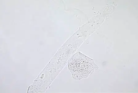 hyaline-casts-in-urine