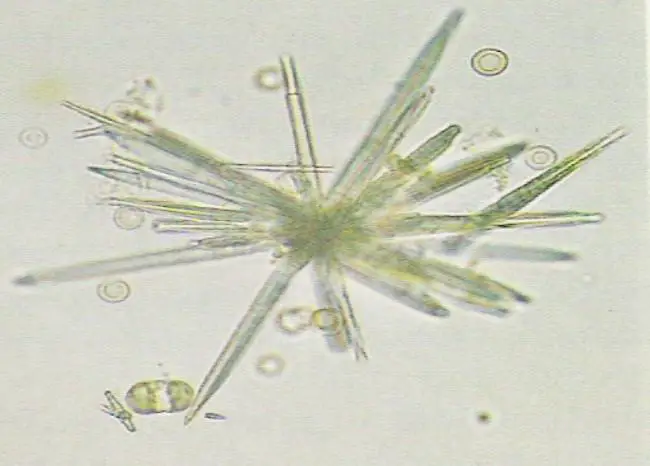 sulfa-crystals-in-urine