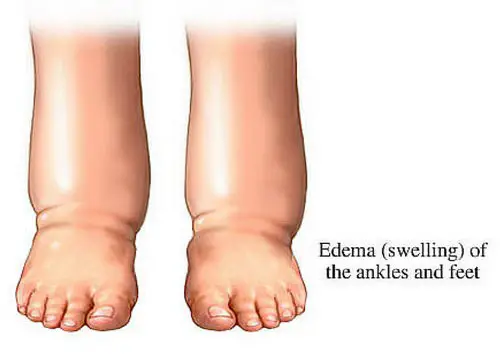 Edema of the ankles and feet image photo picture