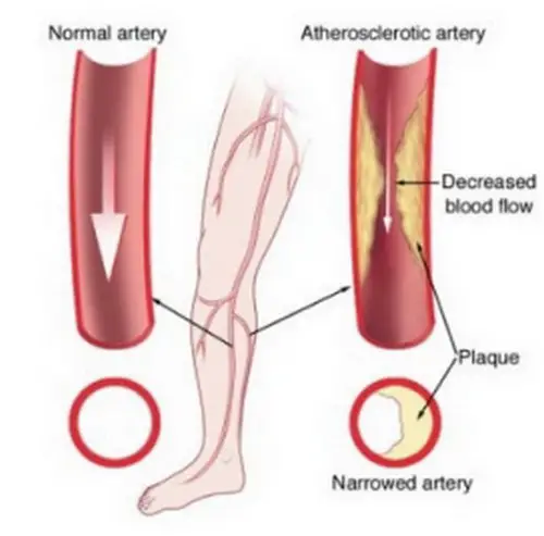 A comparison image between a normal artery and atherosclerotic artery