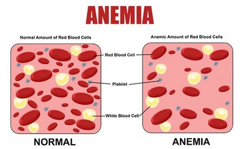 Anemia is one of the leading causes of low MCH reading