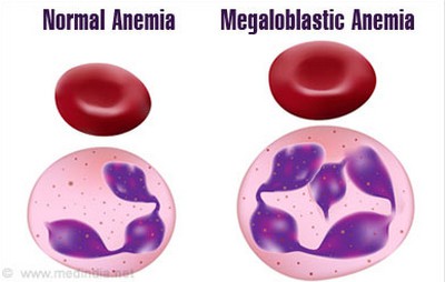 MCH is dramatically high in patients with megaloblastic anemia