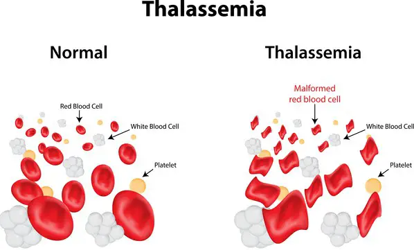 Thalassemia is also linked with the decrease in MCH reading