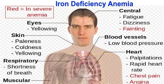 classic manifestations of patients with iron deficiency anemia