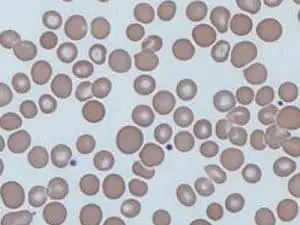 What is Anisocytosis ? Causes, Types and Vs Poikilocytosis