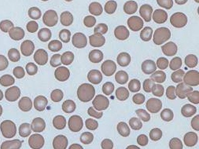 red blood cell (RBC) distribution with noticeable uneven size and shapes