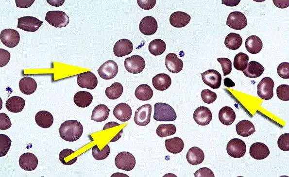hematologic examination showing a closer image of target cells