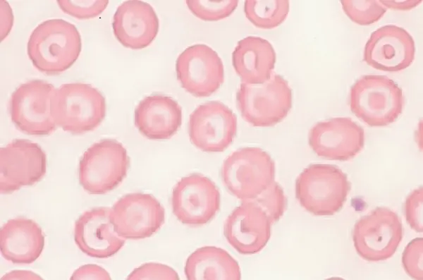 standard hematologic investigation revealed target cells that look like a bulls-eye target