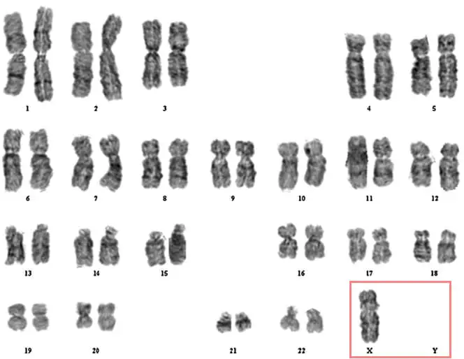 karyotype of a patient with turners syndrome