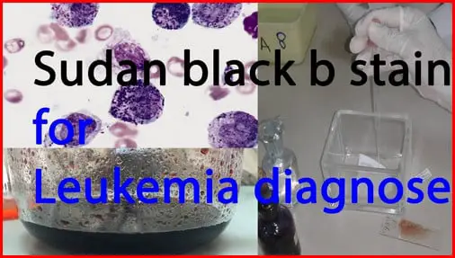 A Sudan Black B stain result for patient diagnosed with leukemia image