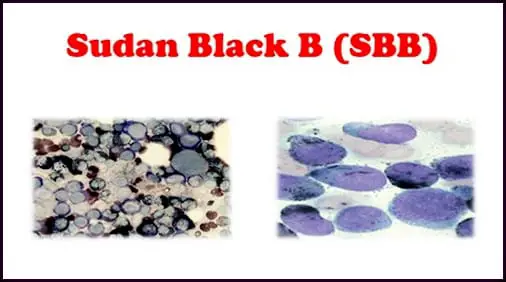 A microscopic image of a specimen that has tested positive for Sudan Black B Stain pictures