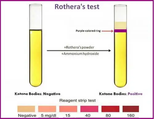 rothera  rotheras test ketone bodies strip test