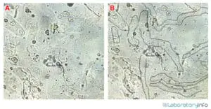 Hyaline Casts in Urine