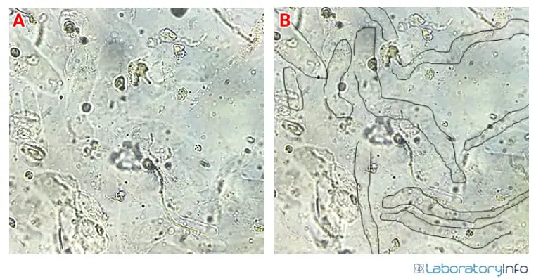 Abundant Hyaline Casts under bright Field microscopy(A) Unmarked (B)marked for better visualization.